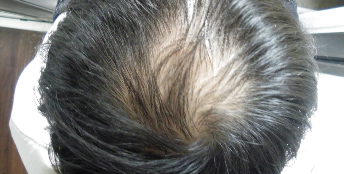 私が自毛植毛にたどり着いた理由